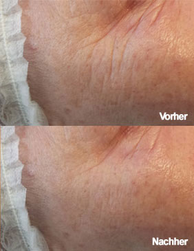 Fadenlifting vorher/nachher Fadenlifting vorher/nachher