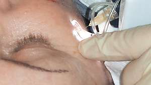 Mesotherapie gegen Falten Mesotherapie gegen Falten